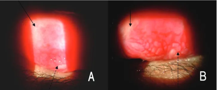 Fig. 1. Giant papillae with flat tops on the upper tarsal conjunctiva (dot-arrow), typically described as a 'cobblestone' appearance  were the hallmark of vernal keratoconjunctivitis and were different in shape compared with hypertrophic conjunctival cicat