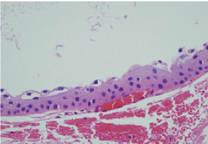Fig. 5. The PAS-stained histopathologic finding. The cyst was  filled with PAS-positive amorphous proteinous materials