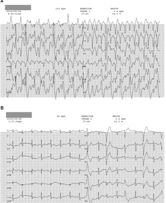 Fig. 1. The results of exercise  stress tests differed significantly (A)  before and (B) after left cardiac  sym-pathetic denervation