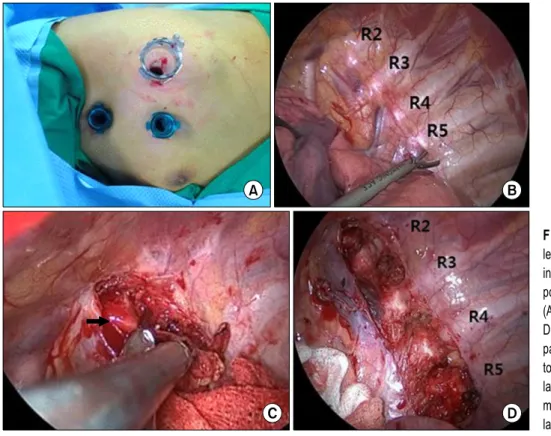 Fig. 3. Intraoperative findings during  left cardiac sympathetic denervation  in a patient with catecholaminergic  polymorphic ventricular tachycardia