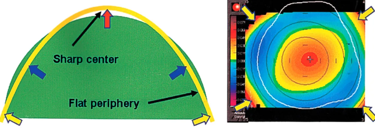Fig. 5. Anterior  elevation  map  of  the  Orbscan  corneal  topography  system  after  myopic  refractive  surgery.