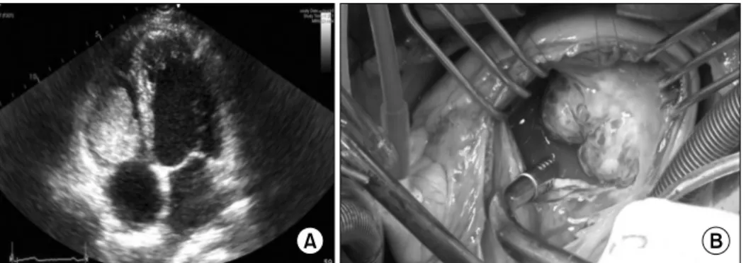 Fig. 1. Preoperative echocardiography and intraoperative findings. (A) A transthoracic long axis view shows a mass in the right ventricle  attached to the tricuspid valve