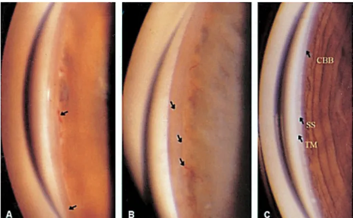 Table 3. Effective  treatment  of  early-onset  and  delayed-onset  glaucoma  after  cataract  surgery 22 eyes had delayed-onset glaucoma (70 to 177 months after 