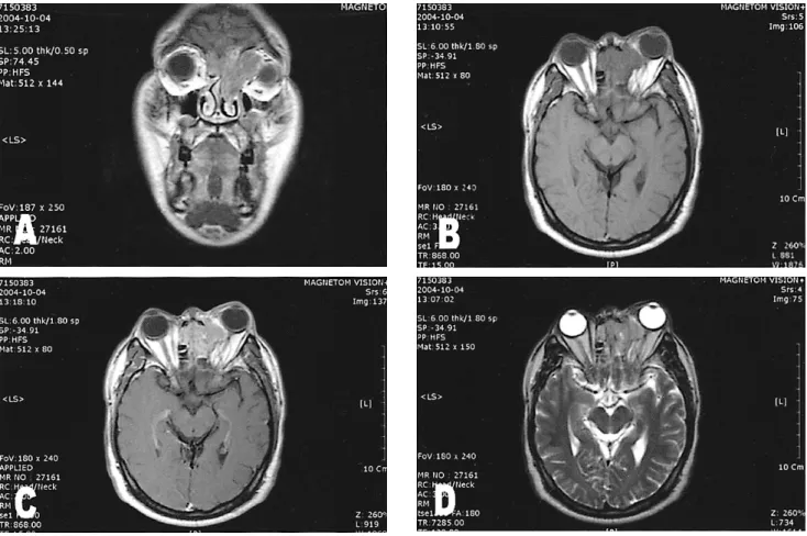Fig. 1. Coronal  (A)  and  axial  (B,C)  CT  scans  show  a  well-circumscribed,  homogeneous  mass  in  the  left  ethmoid  sinus  with  extension  into  the  left  orbit  and  compression  of  the  left  medial  rectus  muscle