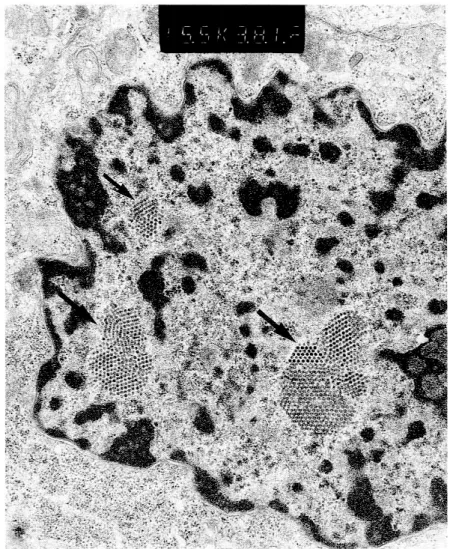 Fig. 2. Electron micrography showing polyomavirus particles arranged in crystalline cluster within the nucleus of tubular cell