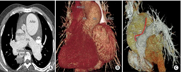 Fig. 1. (A, B) Preoperative computed tomography. This image shows left isomerism, a dilated right superior vena cava, a dilated azygos  vein, and pulmonary stenosis