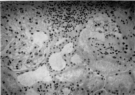 Fig. 1. Interstitial cellular infiltration (grade I); Focal periglomerular lymphocyte infiltration(arrow)., 200