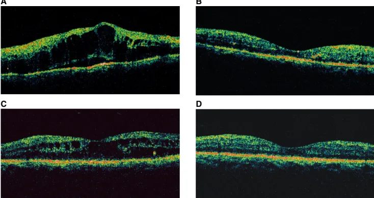 Fig. 2. Central  macular  thickness  in  the  intravitreal  and  posterior  subtenon  injected  eyes  at  baseline  and  at  1  and  3  months  after  triamcinolone  acetonide  injection