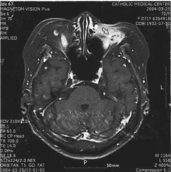 Fig. 2. Profuse  pus  discharge  one  month  after  removal  of  dermo-  fat  graft.