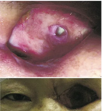 Fig. 6. Final  follow-up.  The  wound  site  was  well  resolved,  and  no  inflammation  or  signs  of  infection  were  found