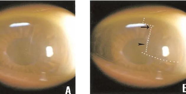 Fig. 1. Diffuse  stromal  edema  (white  shaded  area)  involving  the  pupil  from  the  12  to  4  o’clock  position