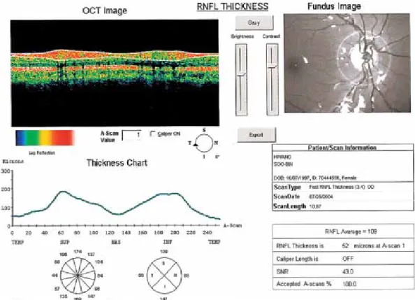 Fig. 2.  Optical coherence tomography of retinal nerve fiber layer  (RNFL) in a patient with hyperopic anisometropic amblyopia.