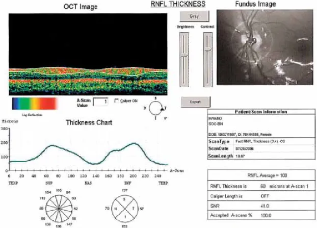 Fig. 3. Optical coherence tomography of retinal nerve fiber layer (RNFL) in the normal eye of a hyperopic anisometropic  amblyopic  patient.