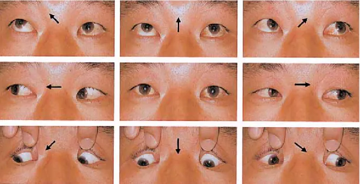 Fig. 3. Photographs of eye movements at one month after the adjustable recession of the left inferior rectus show nearly  complete elevation of the left eye in adduction as well as primary  position.