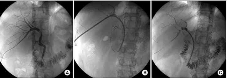Fig. 2. Percutaneous  transhepatic  biliary  stent  insertion.  (A)  The  anastomotic  stricture  before  stent  insertion