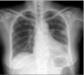 Fig. 2. (A)  Chest  computed  tomography  (CT)  revealed  contrast  enhanced  nodular  consolidations  in  right  upper  lobe  apical  and  left  upper  lobe  apicoposterior  segment