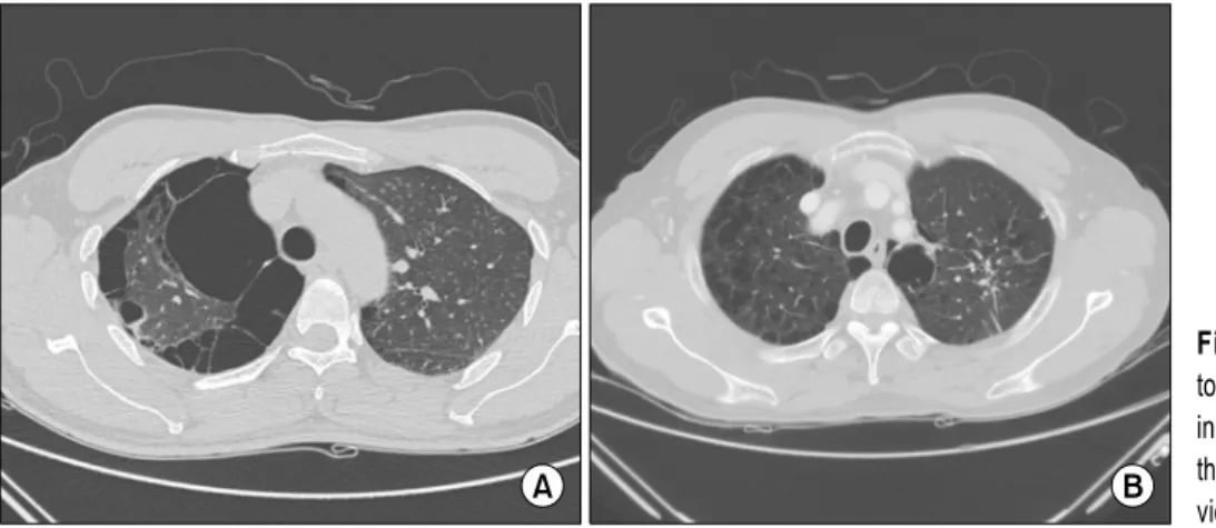 Fig. 1. Typical preoperative computed tomography scan findings of patients  in (A) the single-port VATS and (B)  the three-port VATS groups