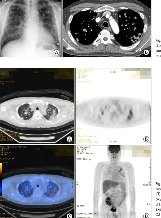 Fig. 1. (A)  Initial  simple  chest  ra- ra-diography and (B) chest computed tomography showed multiple  pul-monary  nodules.