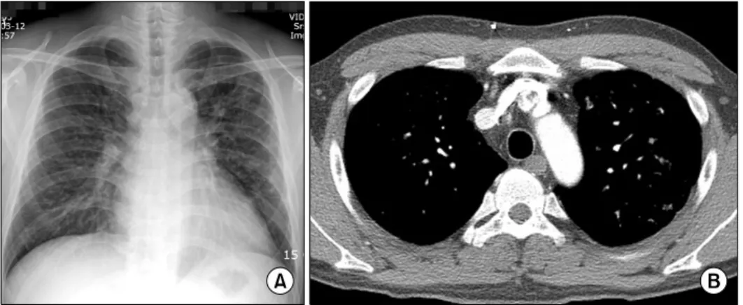 Fig. 5. (A)  Sixth  month  follow-up  simple  chest  radiography  and  (B)  chest computed tomography showed complete  remission.그  외에  다른  부위에는  특이  소견을  보이지  않았다(Fig