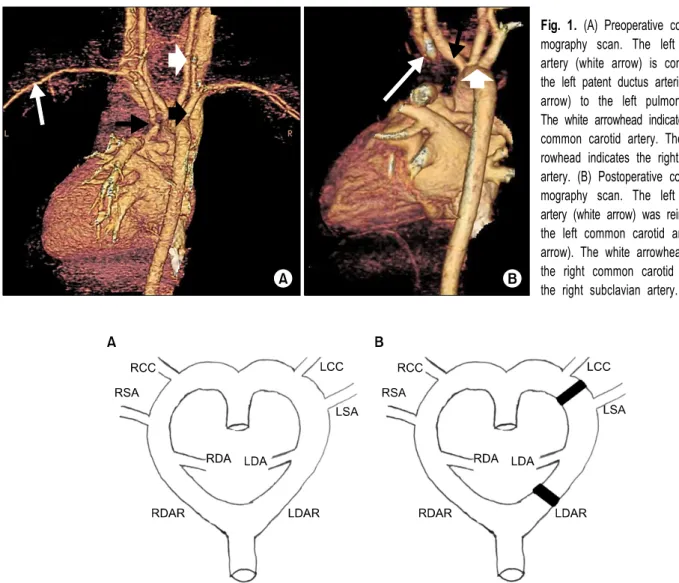 Fig. 1. (A) Preoperative computed to- to-mography scan. The left subclavian  artery (white arrow) is connected via  the left patent ductus arteriosus (black arrow) to the left pulmonary artery