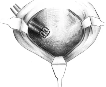 Fig. 2. Surgical  technique.  1)  A  double  armed  4.0  vicryl  suture  was  placed  on  each  tips  of  the  ureter;  2)  both  needles  were  passed from the inside out through the bladder wall; and 3) the ureters  were  pulled  into  the  bladder  and 