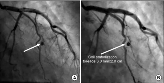 Fig. 3. Coronary angiographic fin- fin-dings of the patient. (A) The short  arrow  indicates  saccular   aneurys-mal  change  in  the  distal  part  of  the obtuse marginal branch of the  left circumflex artery