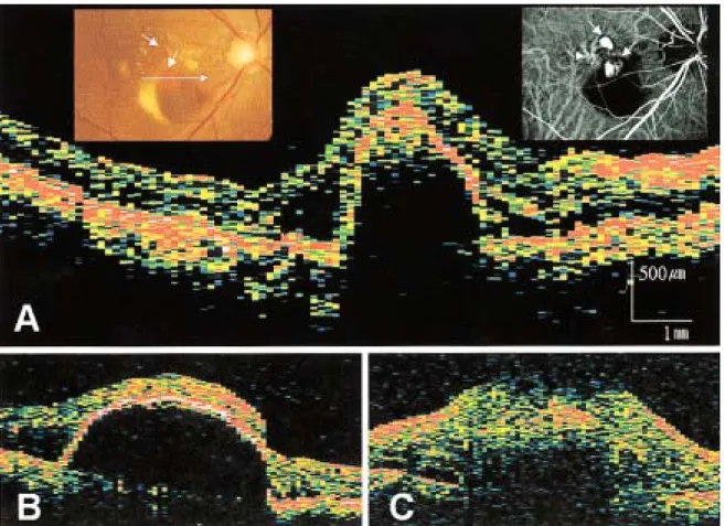 Fig. 1. (A)  Fundus  photogram  of  the  right  eye  shows  pigment  epithelial  detachment,  subretinal  hemorrhages  and  orange-red  nodular  elevations  of  the  retinal  pigment  epithelium  (arrows)