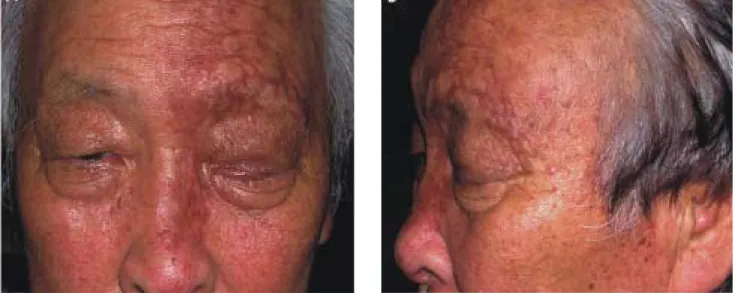 Fig. 2. Nine  cardinal  directions  of  ocular  movement  at  an  early  stage  of  disease