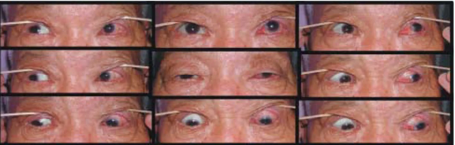 Fig. 3. Nine  cardinal  directions  of  ocular  movement  at  six  months  after  disease  onset