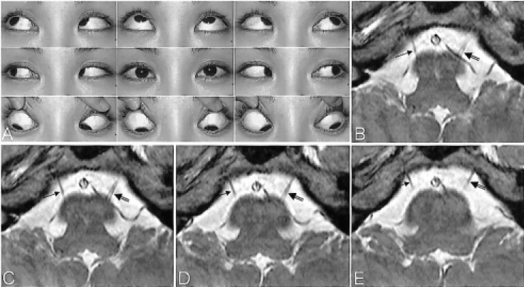 Fig. 1. (A)  Ocular  versions  demonstrating  normal  eye  movement  in  both  eyes.  (B-E)  Four  0.7-mm-thick  slice  images  obtained  with  a  T2-weighted  3D  fast  field  echo  MRI  sequence  show  a  single  right  abducens  nerve  (arrows),  and  a