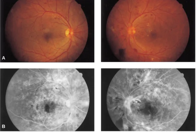 Fig. 1. Case 1. (A) Top: With proliferative DM retinopathy, neovascularization of the optic disc is seen on both eyes