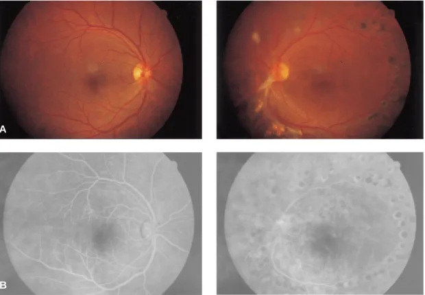 Fig. 2. Case 1. (A) Top: Neovascularization of the optic disc has disappeared on both eyes