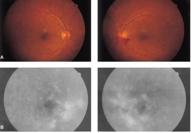 Fig. 3. Case 2. (A) Top: With proliferative DM retinopathy, neovascularization of the optic disc is seen on both eyes