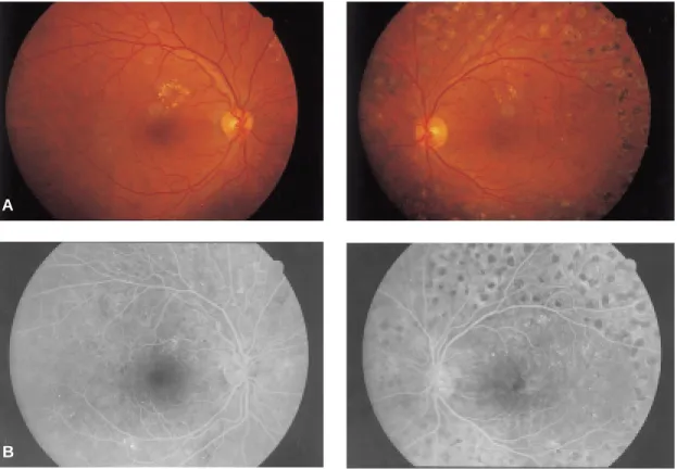 Fig. 4. Case 2. (A) Top: neovascularization of the optic disc has disappeared and some hard exudates are seen at the posterior pole on both eyes