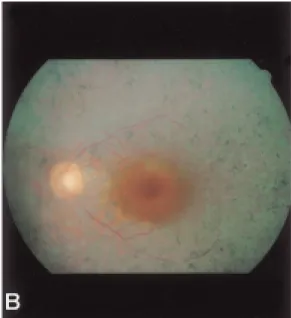 Fig. 2. Slit lamp photograph. IOL dislocation in the right eye after pupil dilation six years after  pha-coemulsification can be seen.