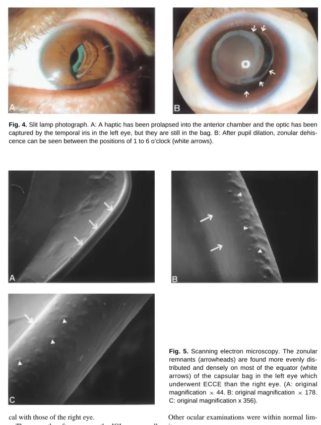 Fig. 5. Scanning electron microscopy. The zonular remnants (arrowheads) are found more evenly  dis-tributed and densely on most of the equator (white arrows) of the capsular bag in the left eye which underwent ECCE than the right eye