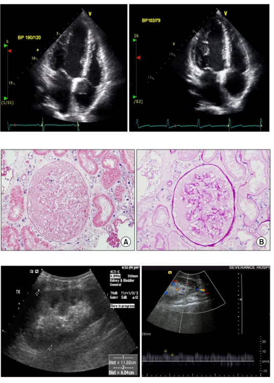 Fig. 3. Sonography of transplanted kidney (postoperative day 15). The transplanted kidney  size was 11.4  cm