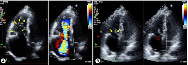 Fig. 1. Echocardiogram of case 1. (A) A preoperative apical four-chamber echocardiogram