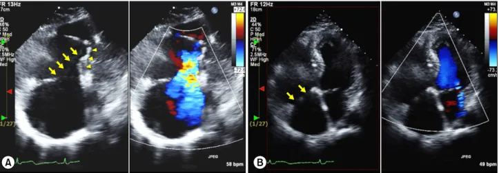 Fig. 2. Echocardiogram of case 2. (A) A large mobile anterior leaflet (arrows) and the displaced septal leaflet (arrow heads)