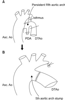Fig. 3. Schematic drawing of persistent fifth aortic arch with coarc- coarc-tation. (A) The isthmic area and ductus arteriosus were divided