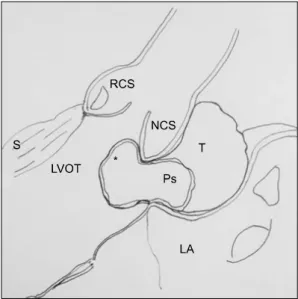 Fig. 2. Schematic diagram of intraoperative findings. LA, left at- at-rium. LVOT, left ventricular outflow tract