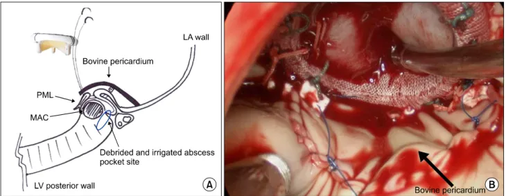 Fig. 3. (A) Schematic illustration of the surgical technique. We passed the valve sutures from the atrial wall to the posterior leaflets, while  avoiding passing through the MAC and obliterating the abscess pocket site