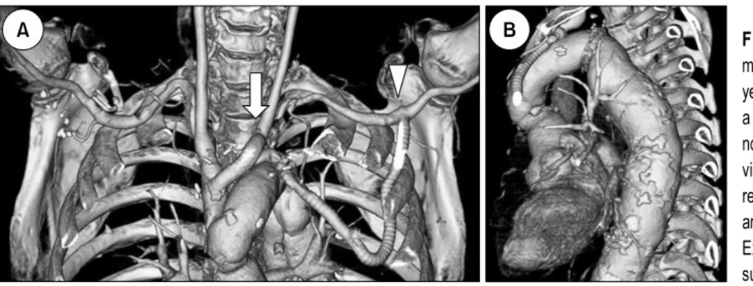 Fig. 3. A postoperative computed to- to-mographic angiogram performed one  year after aortic reconstruction revealed a stable state with no significant  ste-nosis of the bypass graft