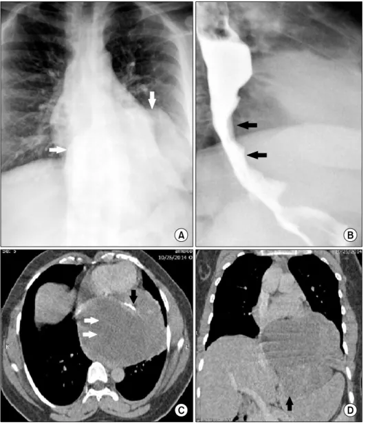 Fig. 1. (A) Chest radiograph show- show-ing a well-defined retrocardiac soft  tissue mass (white arrows) with  in-tra-abdominal extension