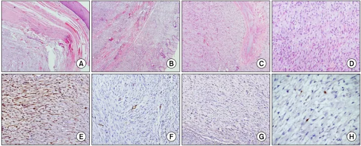 Fig. 2. Photomicrographs show (A) a well-circumscribed spindle cell lesion arising from the lower end of the esophagus (H&amp;E, ×40) and  (B) reaching up to the gastric fundus (H&amp;E, ×40)