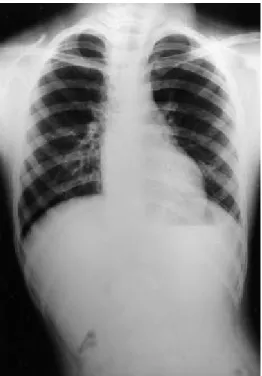 Fig. 4. P re ope ra tive che s t CT : In the Lt. a nt. me dia s tinum, it is s e e n 10 10 8 cm s ize d e nca ps ula te d ma s s including s olid compone nt, fa t, multiple ca lcifie d nodule s .