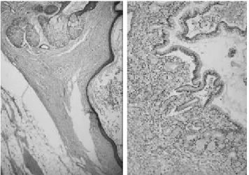 Fig . 5,6. The tumor, me s uring 14 13 7 cm, is we ll e nca ps ula te d with foca l a dhe s ion of fa t tis s ue 