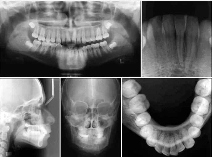 Fig 3. The tooth-supported distractor. The distractor  was fabricated with a hyrax screw, two premolar  bands, and two molar bands