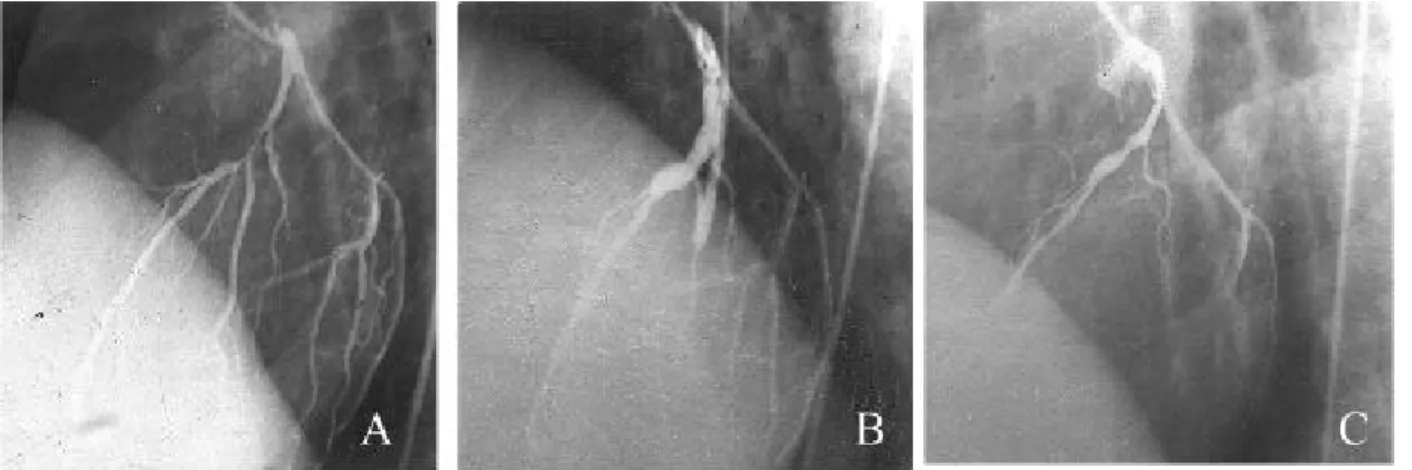 Fig. 2. Corona ry a ngiogra phy A: