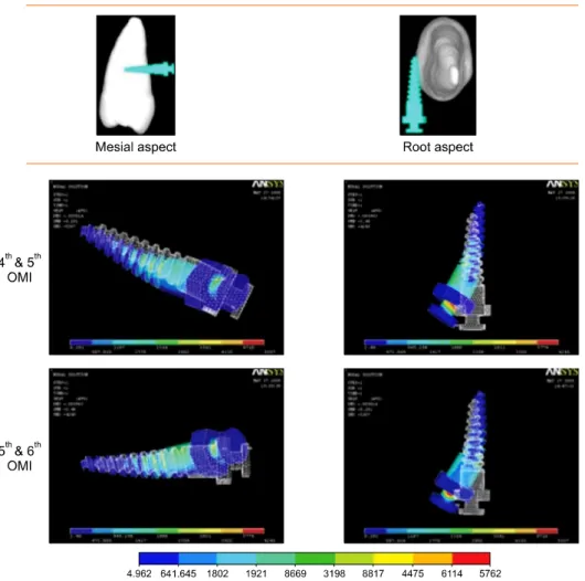 Fig 3. Displacement of the orthodontic mini-implant according to its position (magnification, × 500)